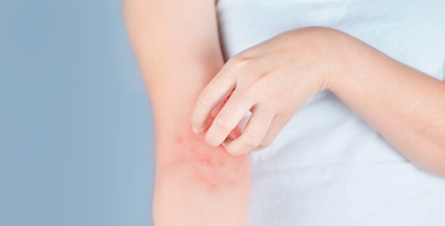 eczema prone