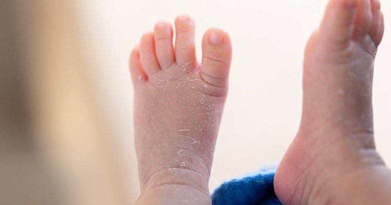 Here’s How You Can Keep Your Child’s Eczema Flare Ups Under Control!